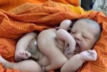 Nace un bebé indio con cuatro brazos y cuatro piernas