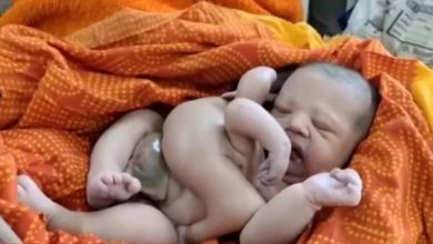 Nace un bebé indio con cuatro brazos y cuatro piernas